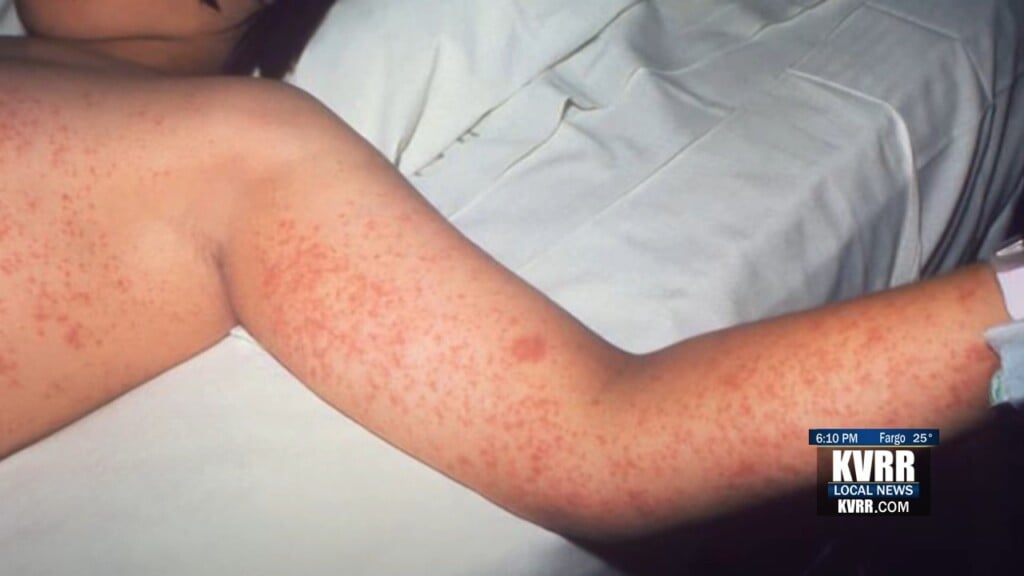 Measles