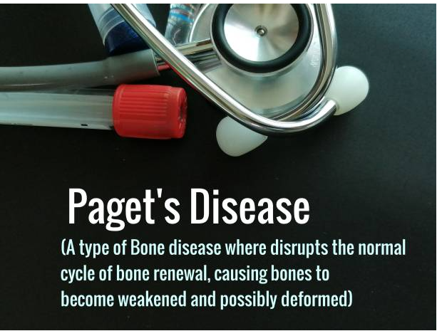 Pavatalgia Disease