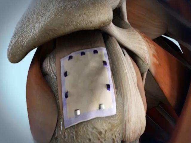 Nc Rotatorcuff0205 Mezzn